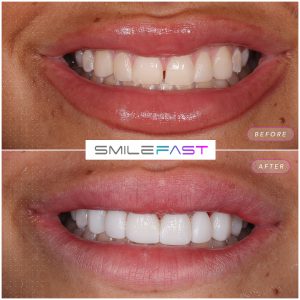 Smile Makeover