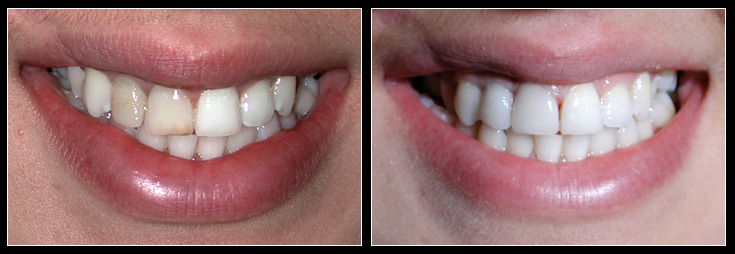 Discoloured teeth whitened