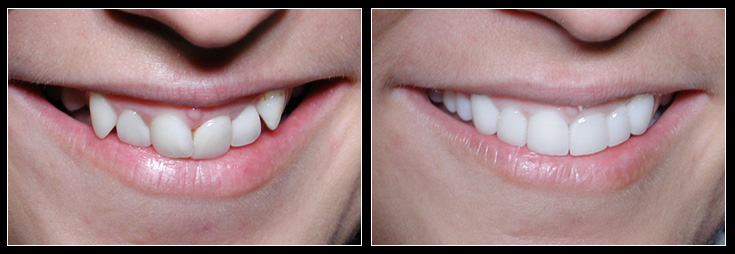 Smile Makeover With Veneers